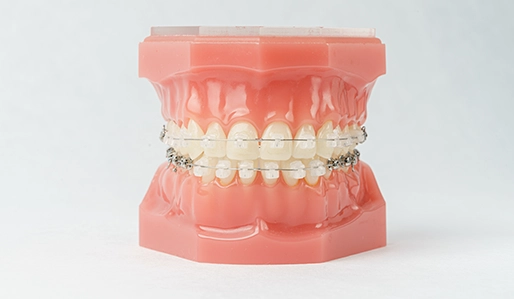 歯型の採取を最初の1回で完結